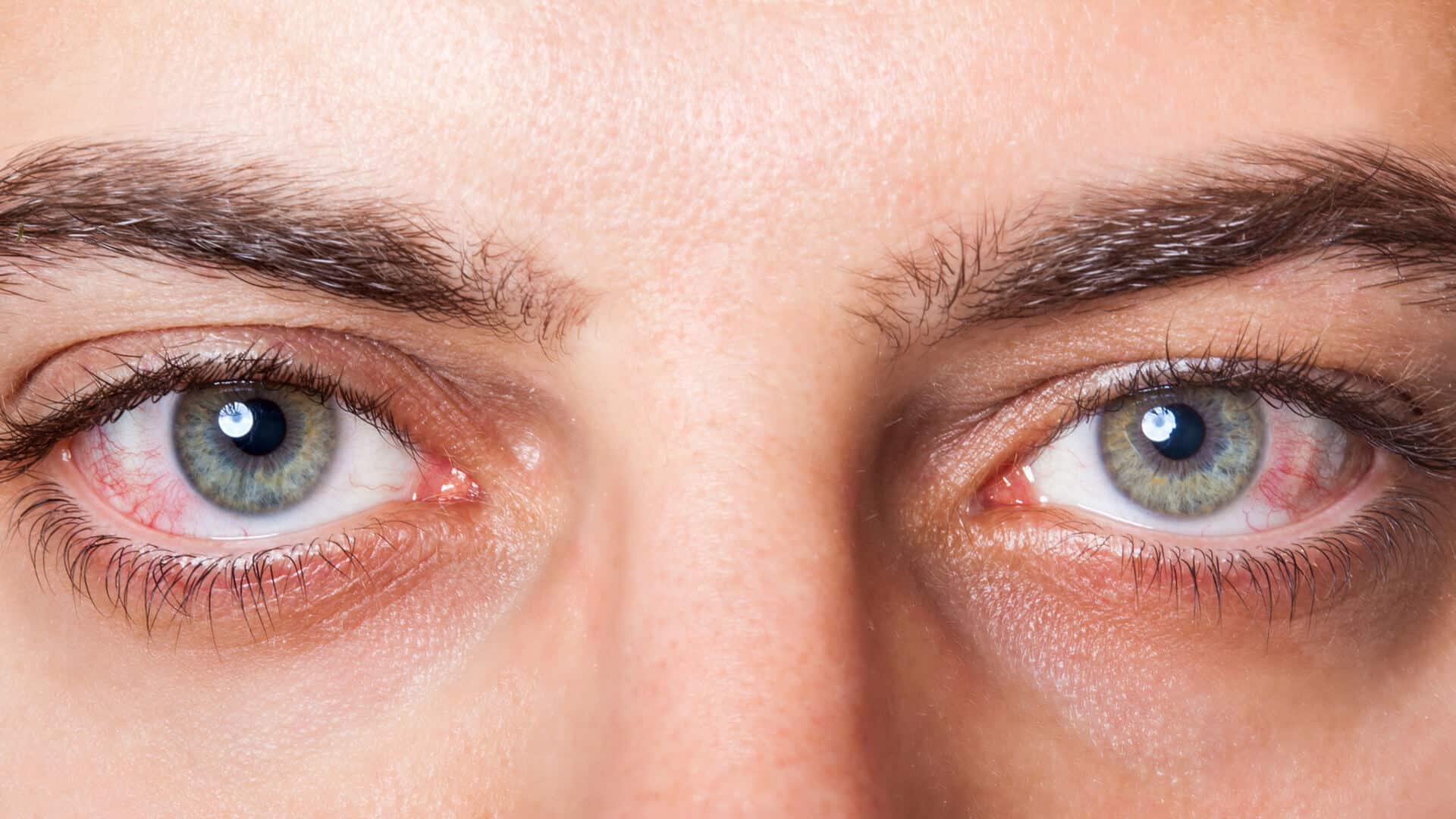 جفاف العين - الأعراض و طرق الوقاية و العلاج