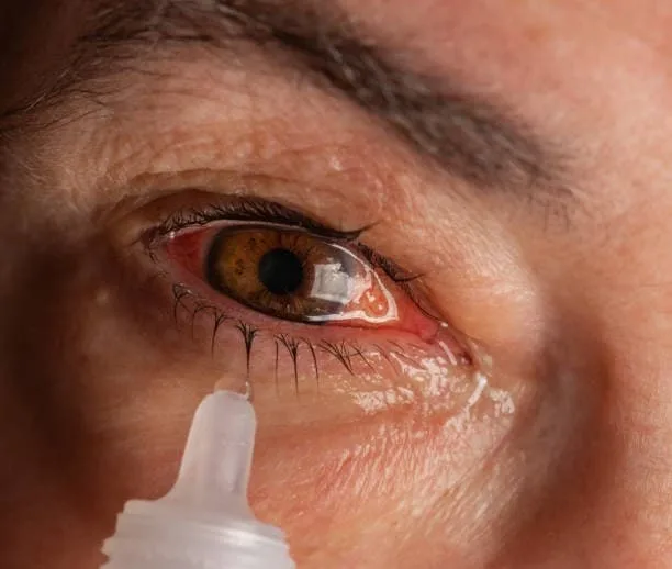 جفاف العين - الأعراض و طرق الوقاية و العلاج
